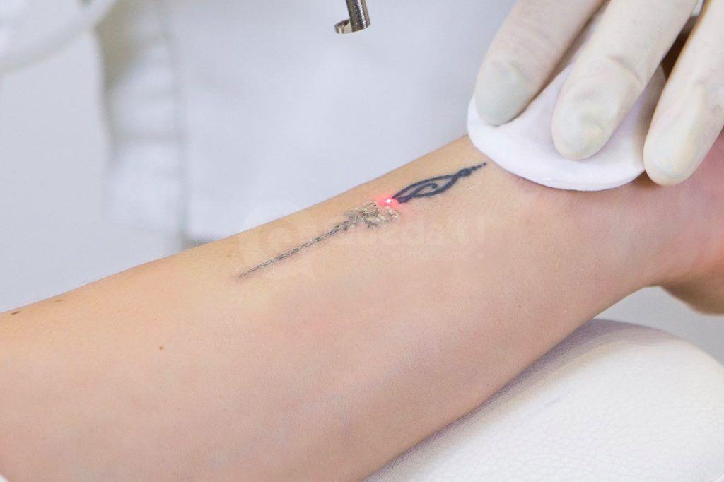 tatuatge-eliminar-laser-mataro